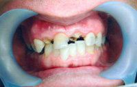 Full Mouth Reconstruction Near Me