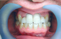 Full Mouth Reconstruction in Erragadda