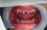 Best Dental Implant Hospital